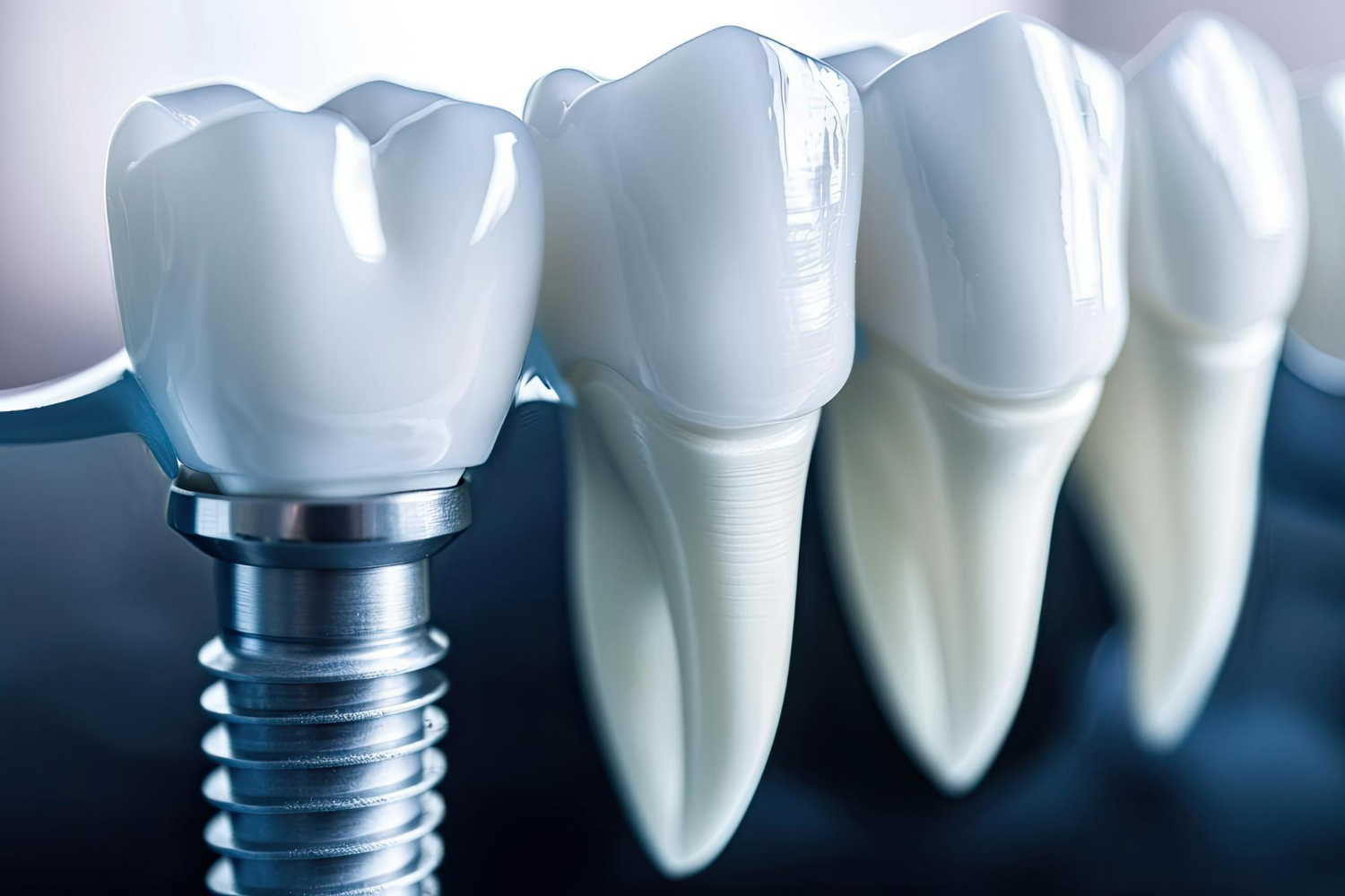 implants